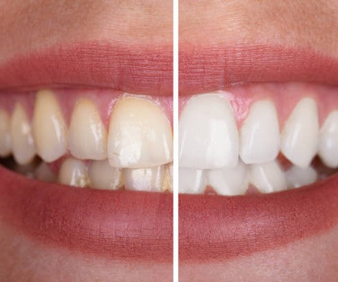 Dental Color Corrector™